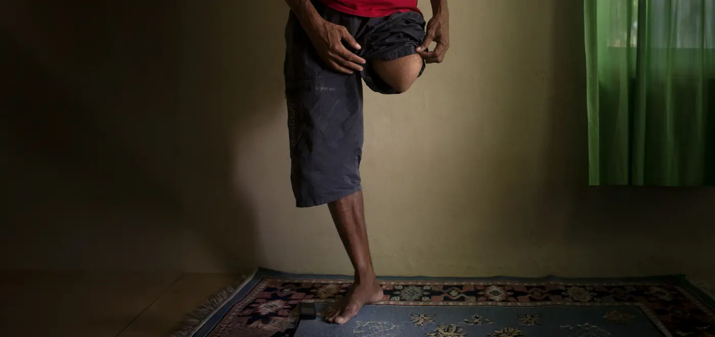 Man standing on one leg, showing the other leg that had been bitten off in a crocodile attack