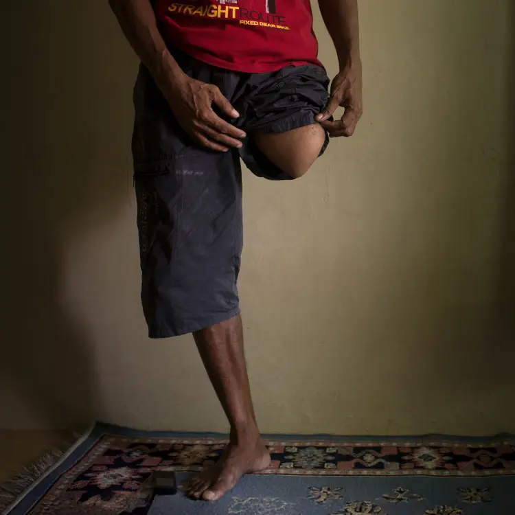 Pria dengan amputasi kaki di atas lutut berdiri di dalam ruangan, mengangkat celananya untuk menunjukkan bagian kakinya.